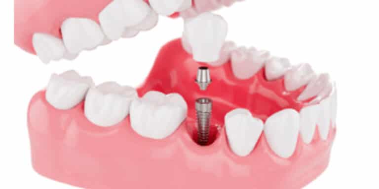 Read more about the article 5 Undeniable Dental Implants Benefits