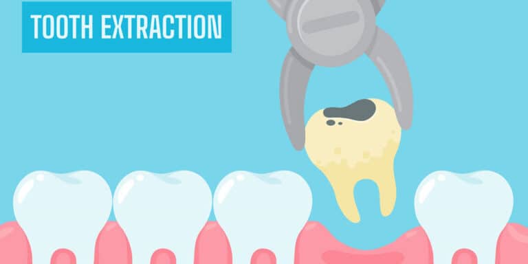 Read more about the article Tooth Extraction Aftercare – The Do’s And The Don’ts