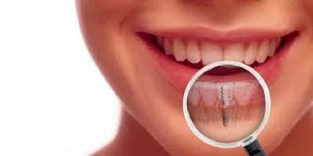 Read more about the article Does Your Smile Catch You Short Due To Missing Teeth?