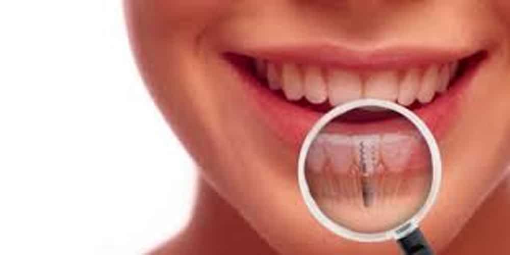 You are currently viewing Does Your Smile Catch You Short Due To Missing Teeth?