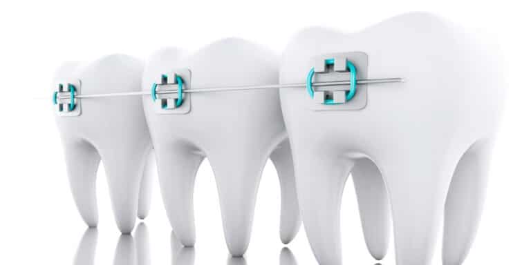 Read more about the article Dental Braces: What Is The Best Age For Braces?