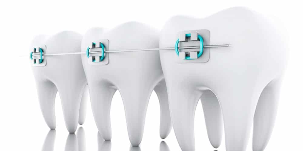 You are currently viewing Dental Braces: What Is The Best Age For Braces?