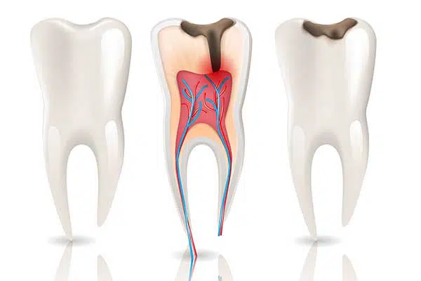 Teeth anchoring