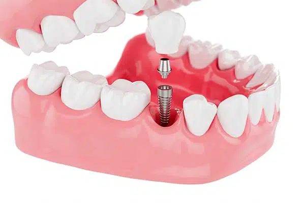 Tooth care