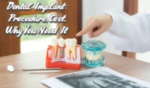 Read more about the article Dental Implant: Procedure, Cost, Why You Need It