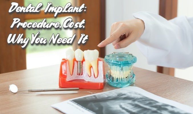 You are currently viewing Dental Implant: Procedure, Cost, Why You Need It