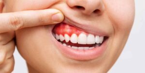 Read more about the article What are the Ways to Keep your Gums Healthy?