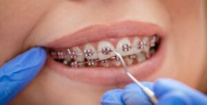 Read more about the article Dental Braces: Advantages Of Invisalign