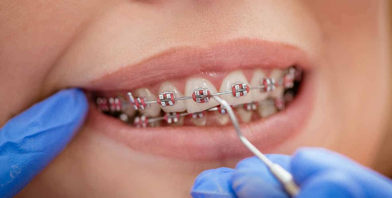 You are currently viewing Dental Braces: Advantages Of Invisalign