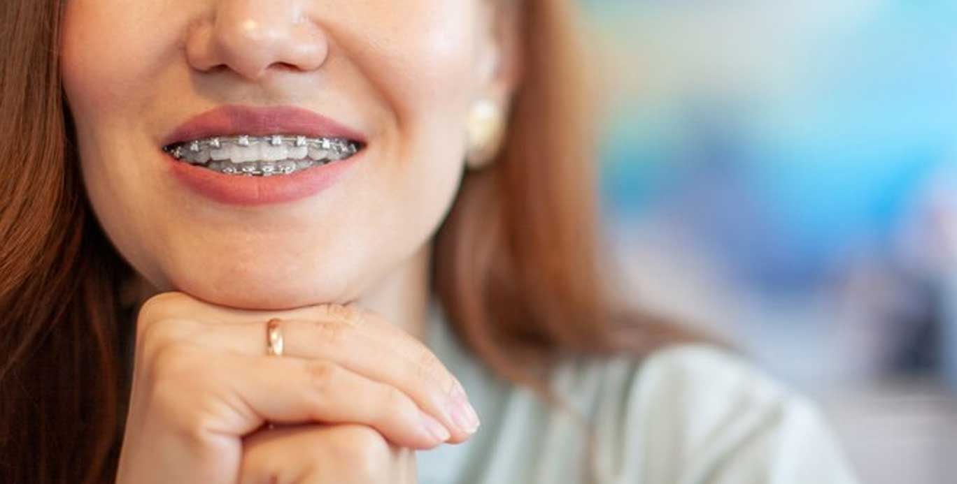 You are currently viewing Straighten Your Smile: Tips for Choosing the Right Teeth Braces Doctor