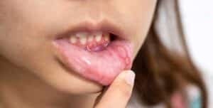 Read more about the article Fighting Oral Cancer: Prevention, Detection, and Treatment