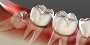 Read more about the article Wisdom Teeth Woes: Causes, Symptoms, and Treatment Options