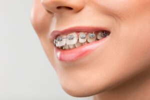 Read more about the article Affordable Dental Braces for Adults and Kids