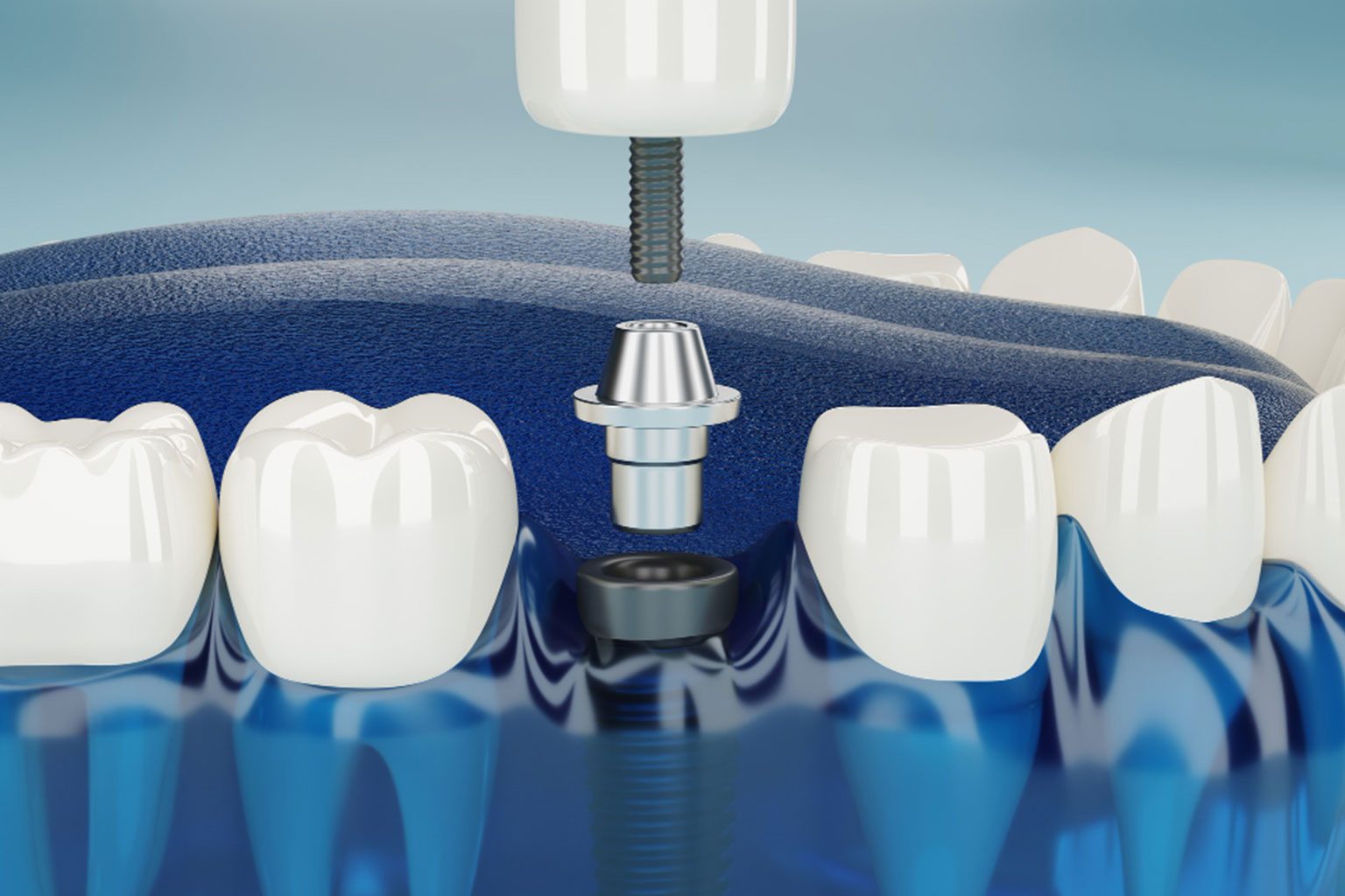 Read more about the article What Are the Phases of the Dental Implant Procedure?