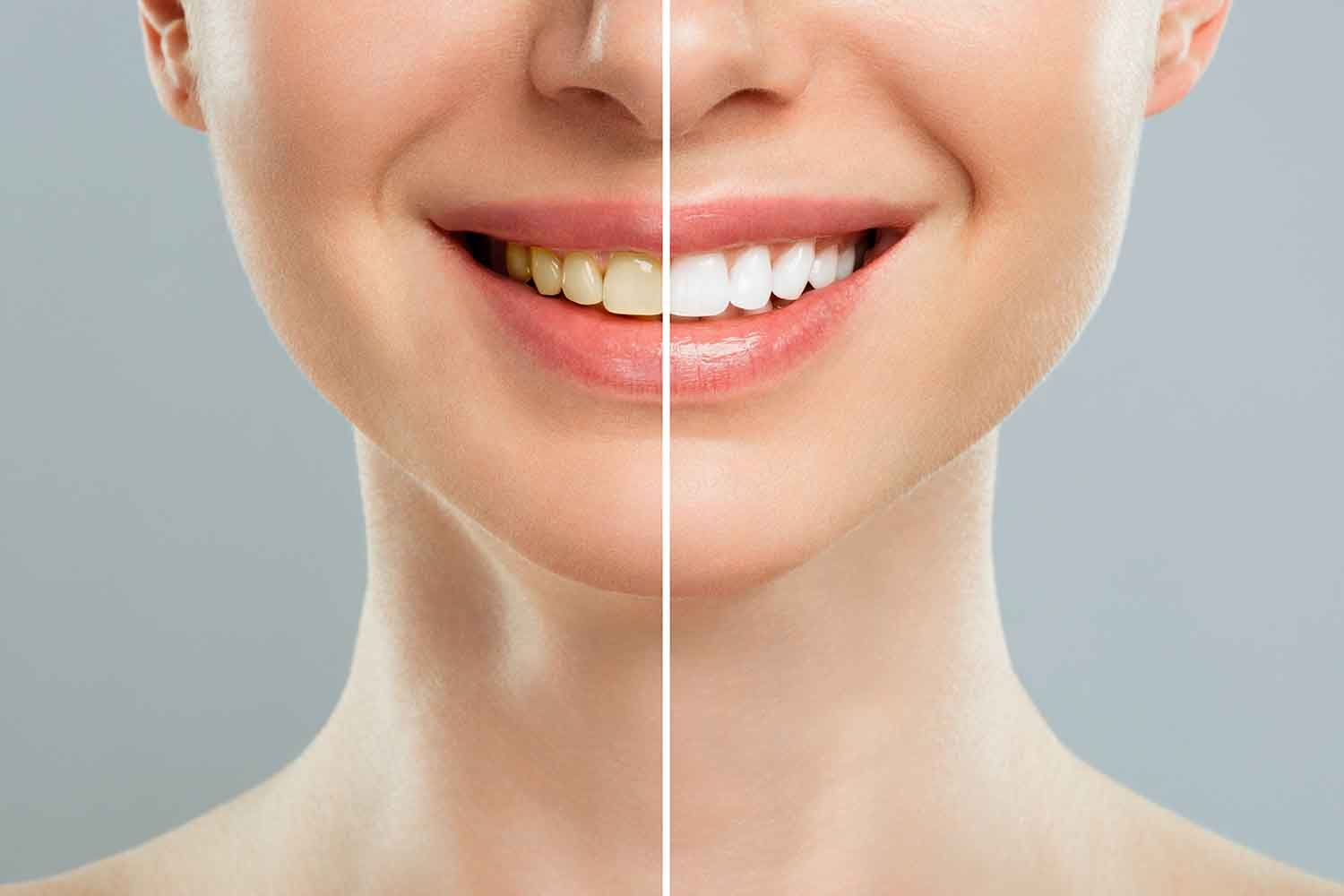 Read more about the article Teeth Whitening at Home vs Clinic – What’s Better?