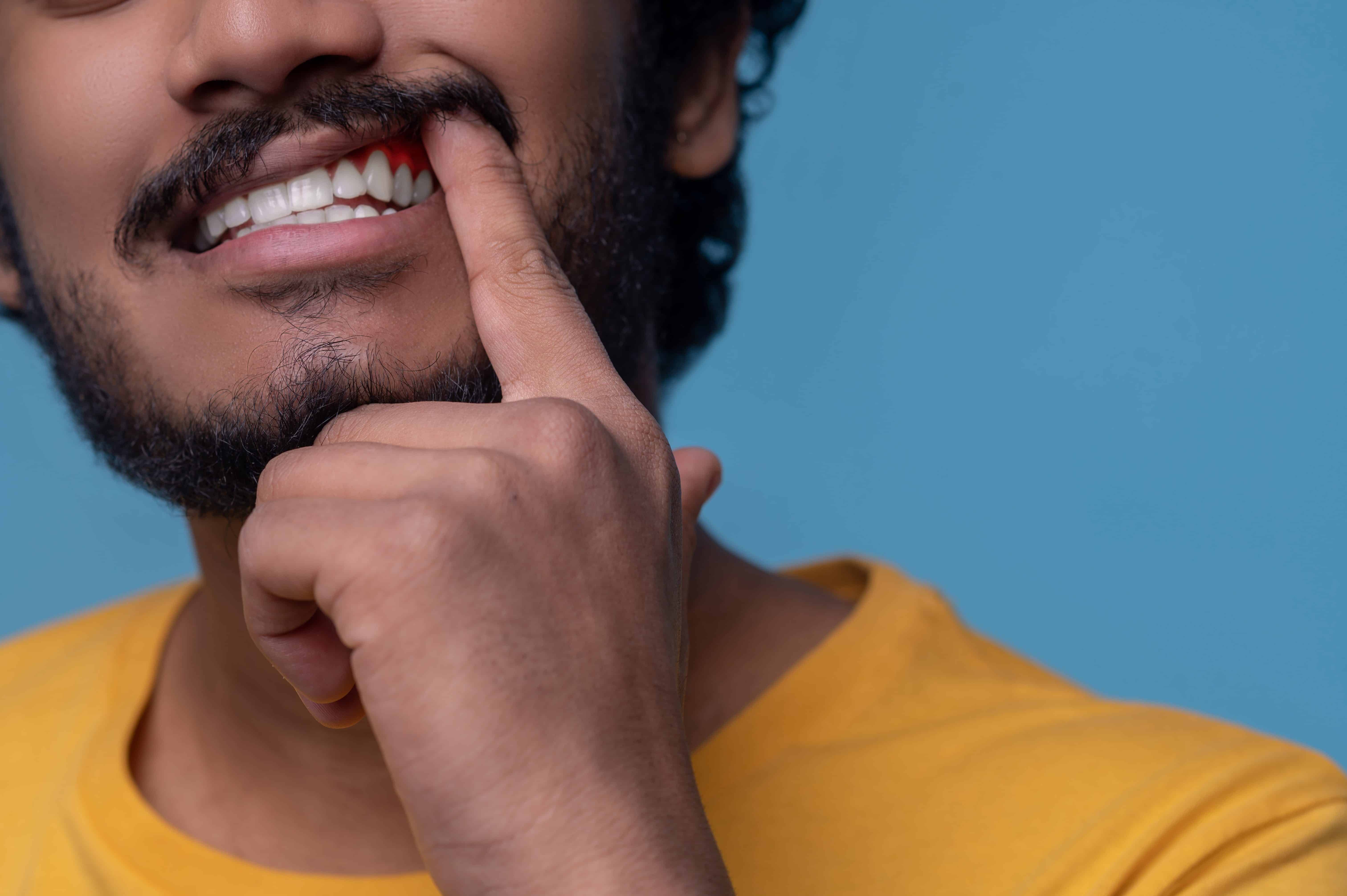 You are currently viewing Swollen Gums: Causes, Symptoms & Treatment in Vizag