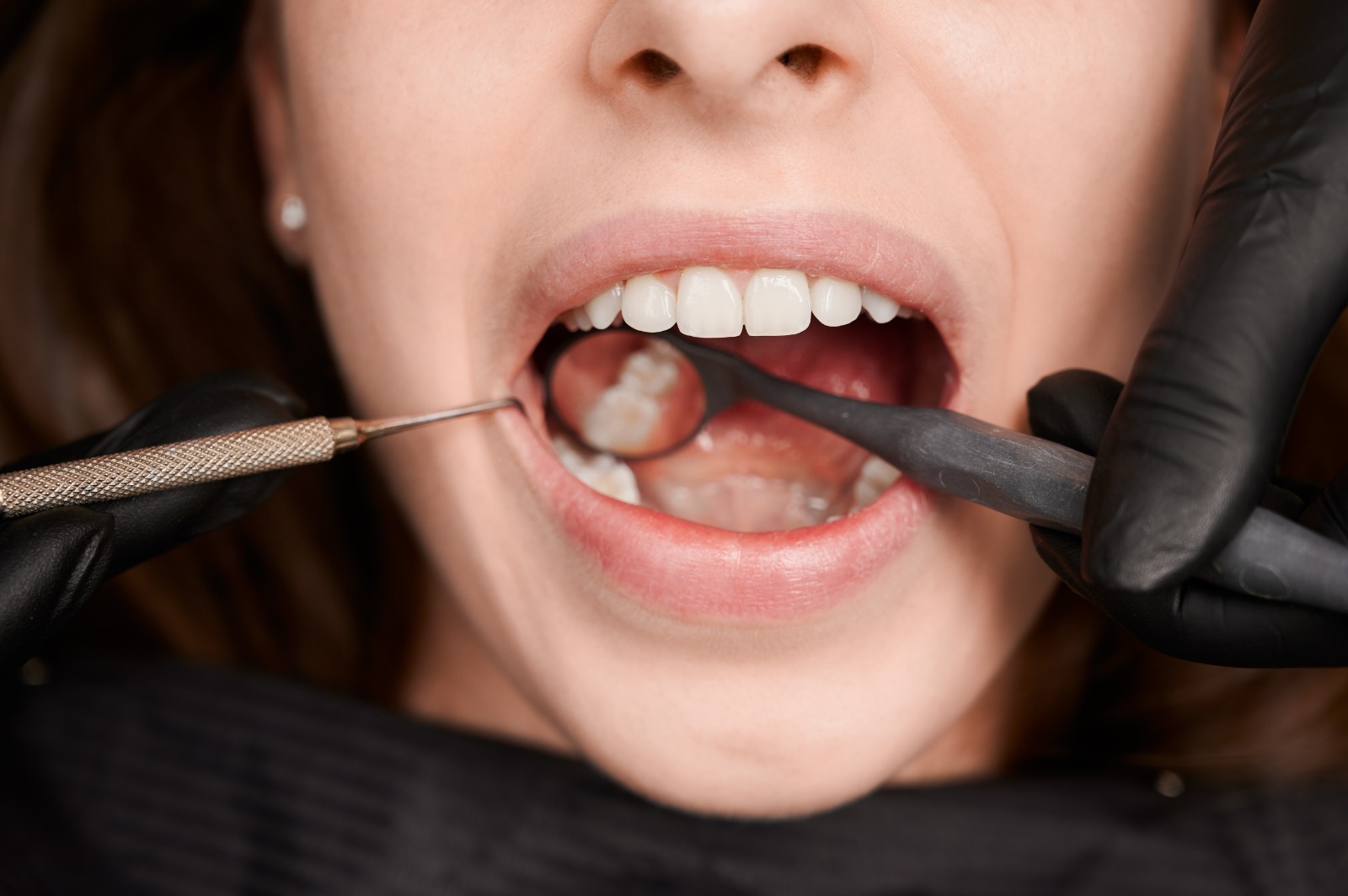 You are currently viewing Why You Might Need a Tooth Extraction Even Without Pain