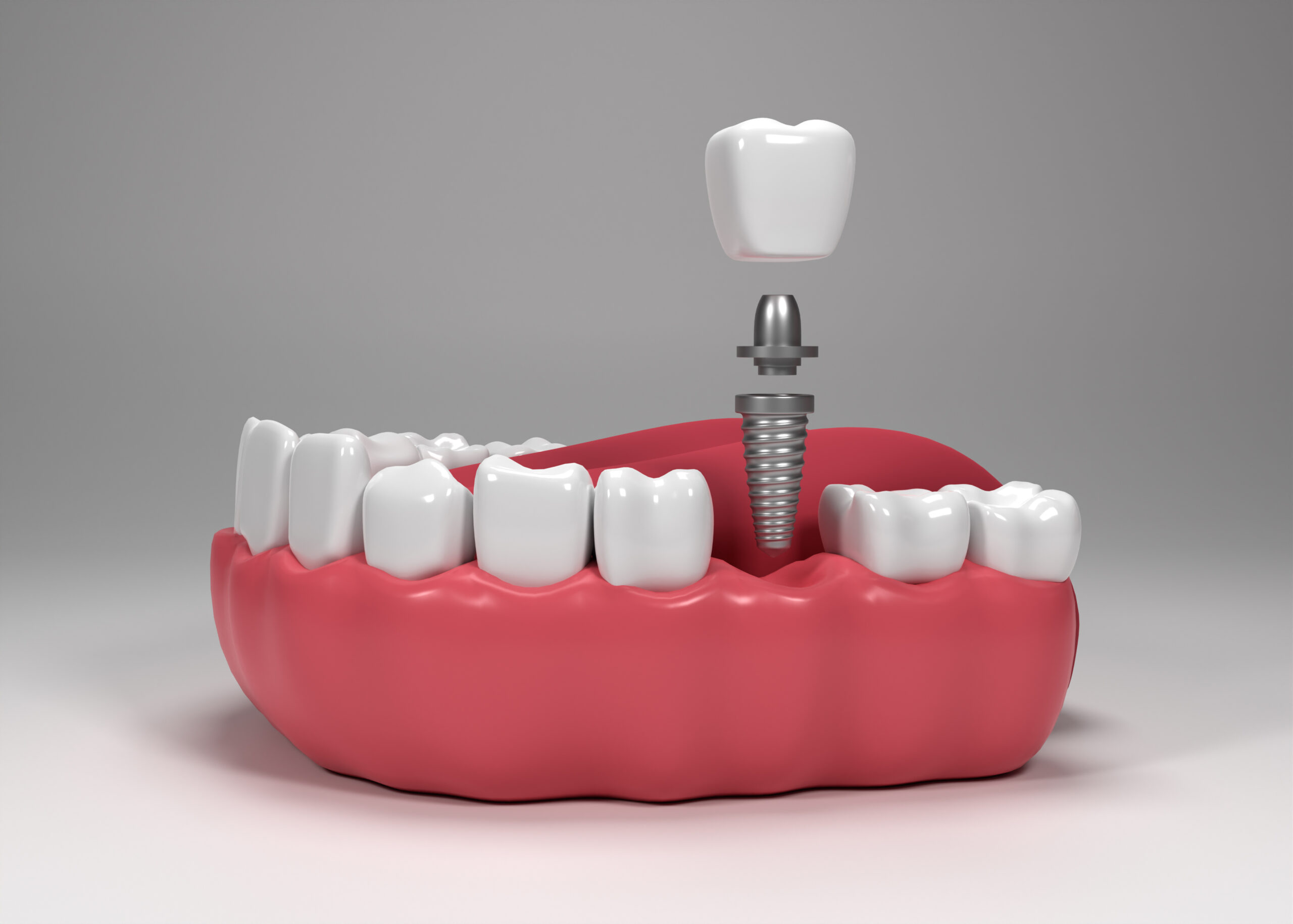 You are currently viewing Dental Implants vs Dentures: Choosing Between Dentures And Dental Implants In Vizag