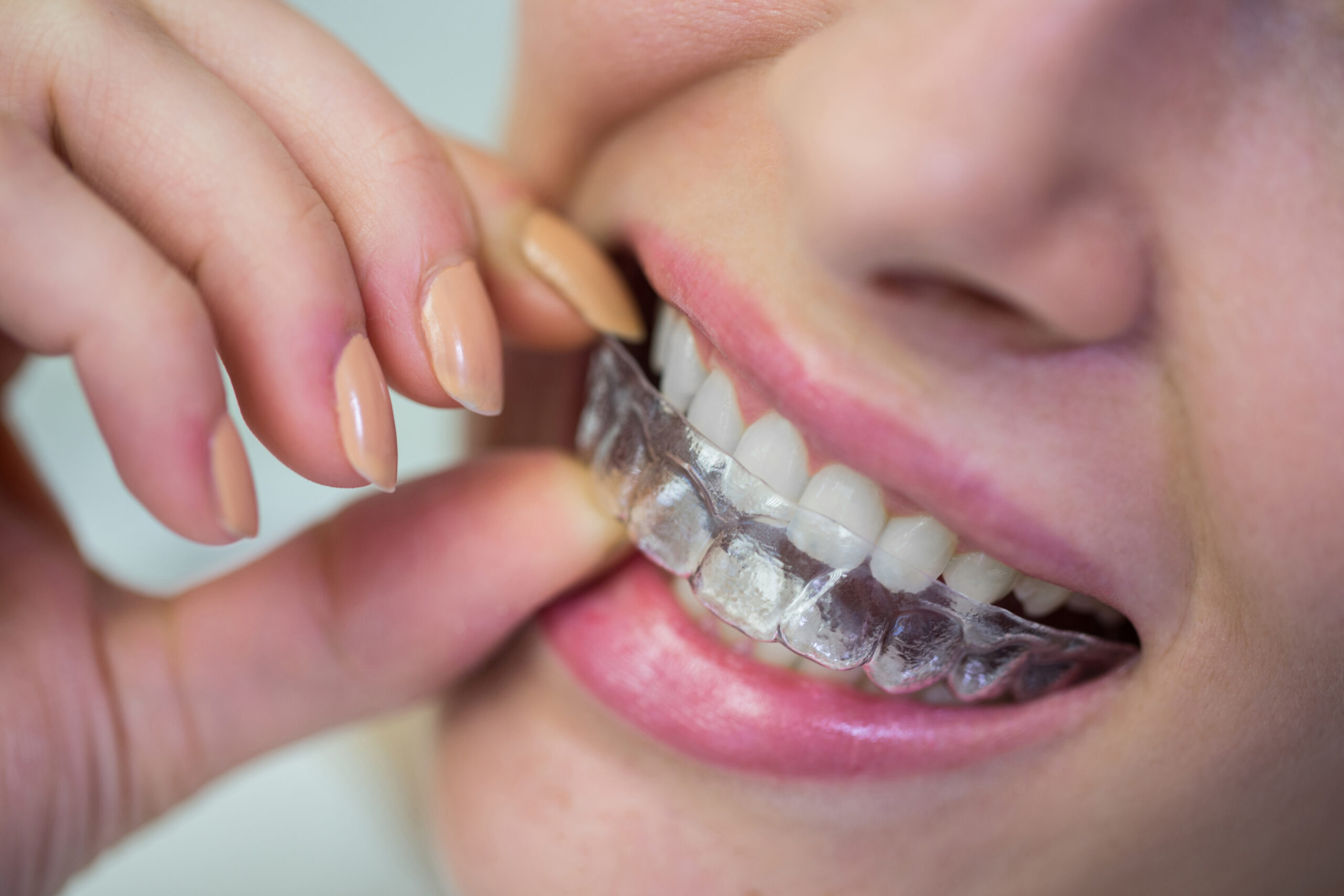 You are currently viewing Are Clear Aligners Worth It? The Honest Cost And Time Guide To The Best Clear Aligners In Vizag